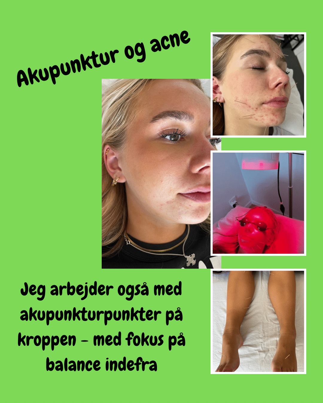 acne-akupunktur-1 Før- og efterbilleder af acneforløb med akupunktur (1)
