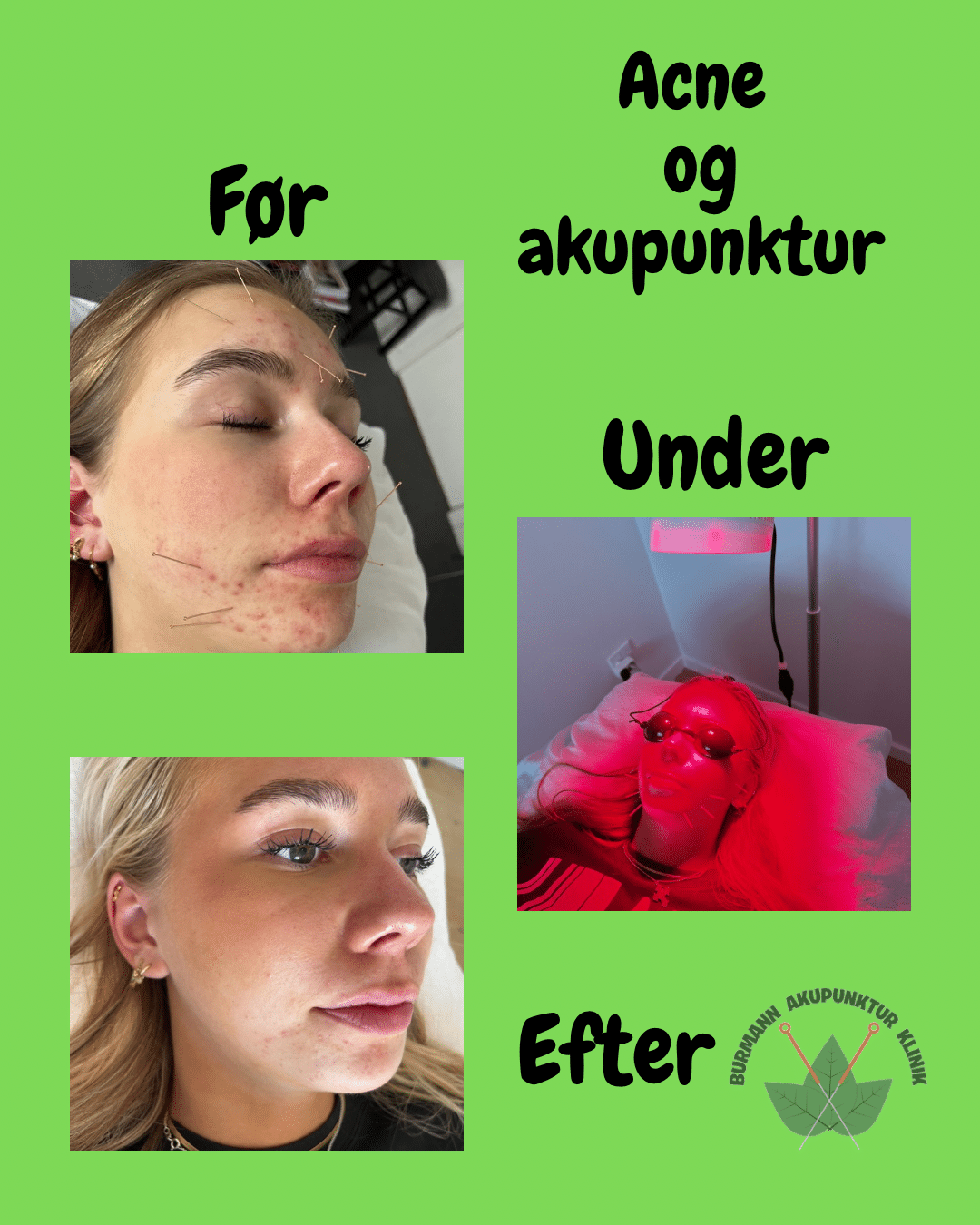 acne-akupunktur-2 Før- og efterbilleder af acneforløb med akupunktur (2)