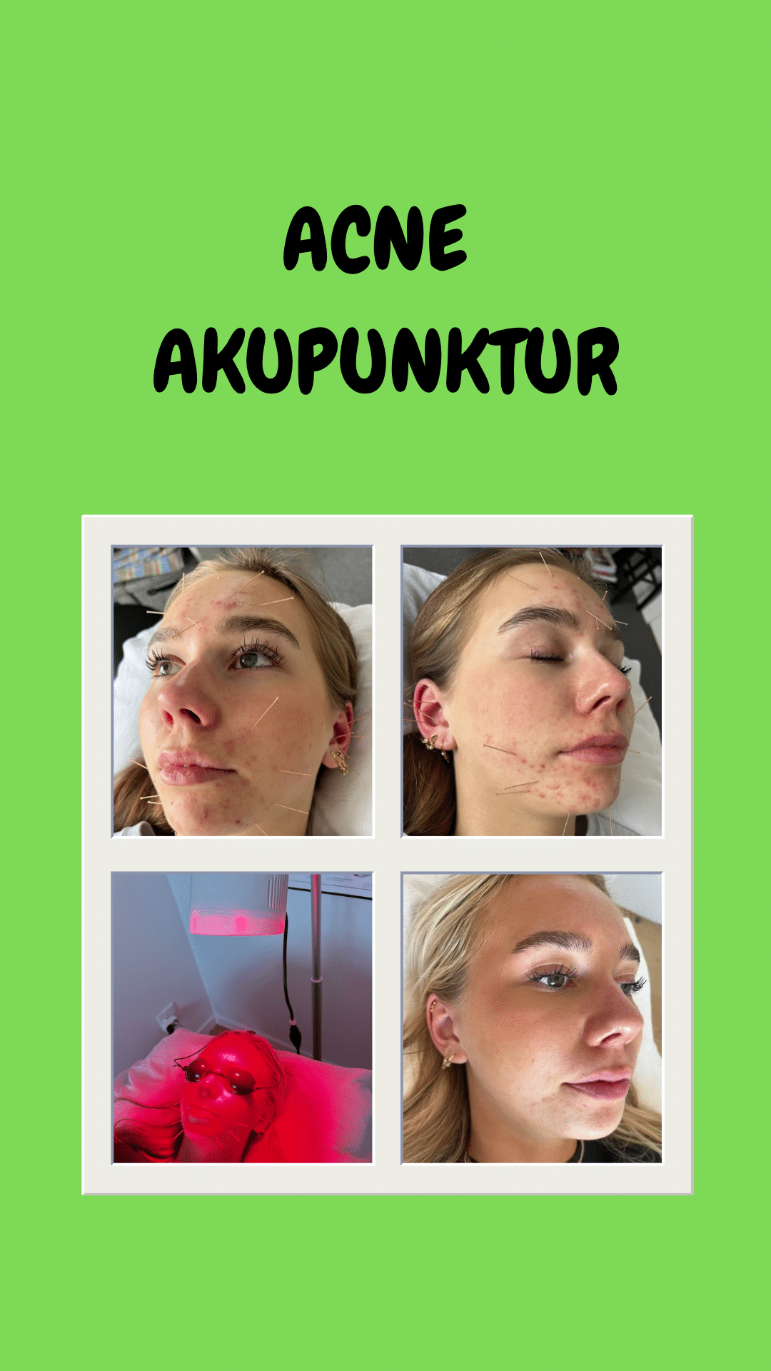 acne-akupunktur-3 Før- og efterbilleder af acneforløb med akupunktur (3)