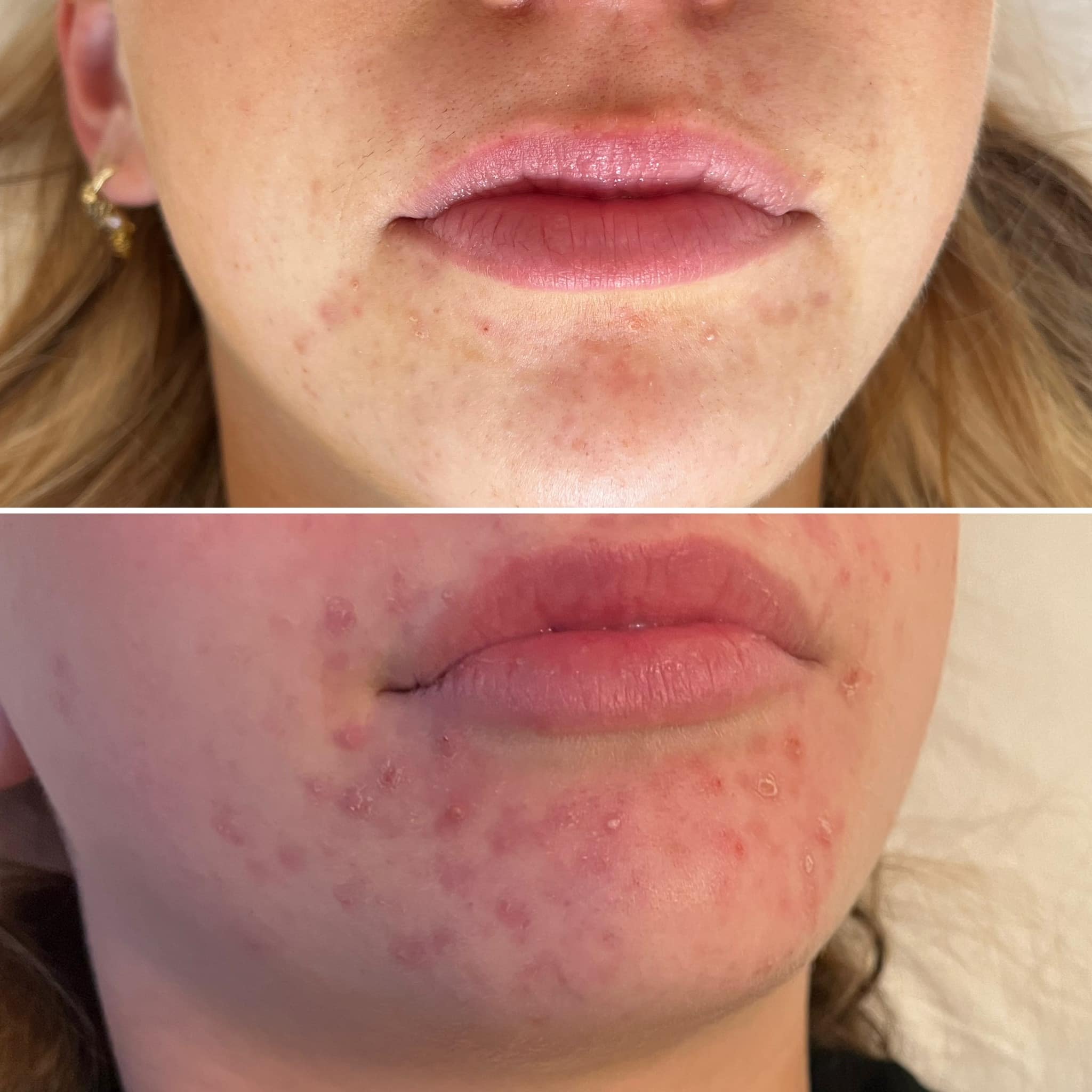 acne-akupunktur-4 Før- og efterbilleder af acneforløb med akupunktur (4)
